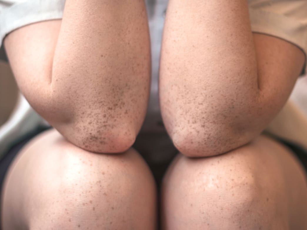 What is Eczema and Who Gets It?