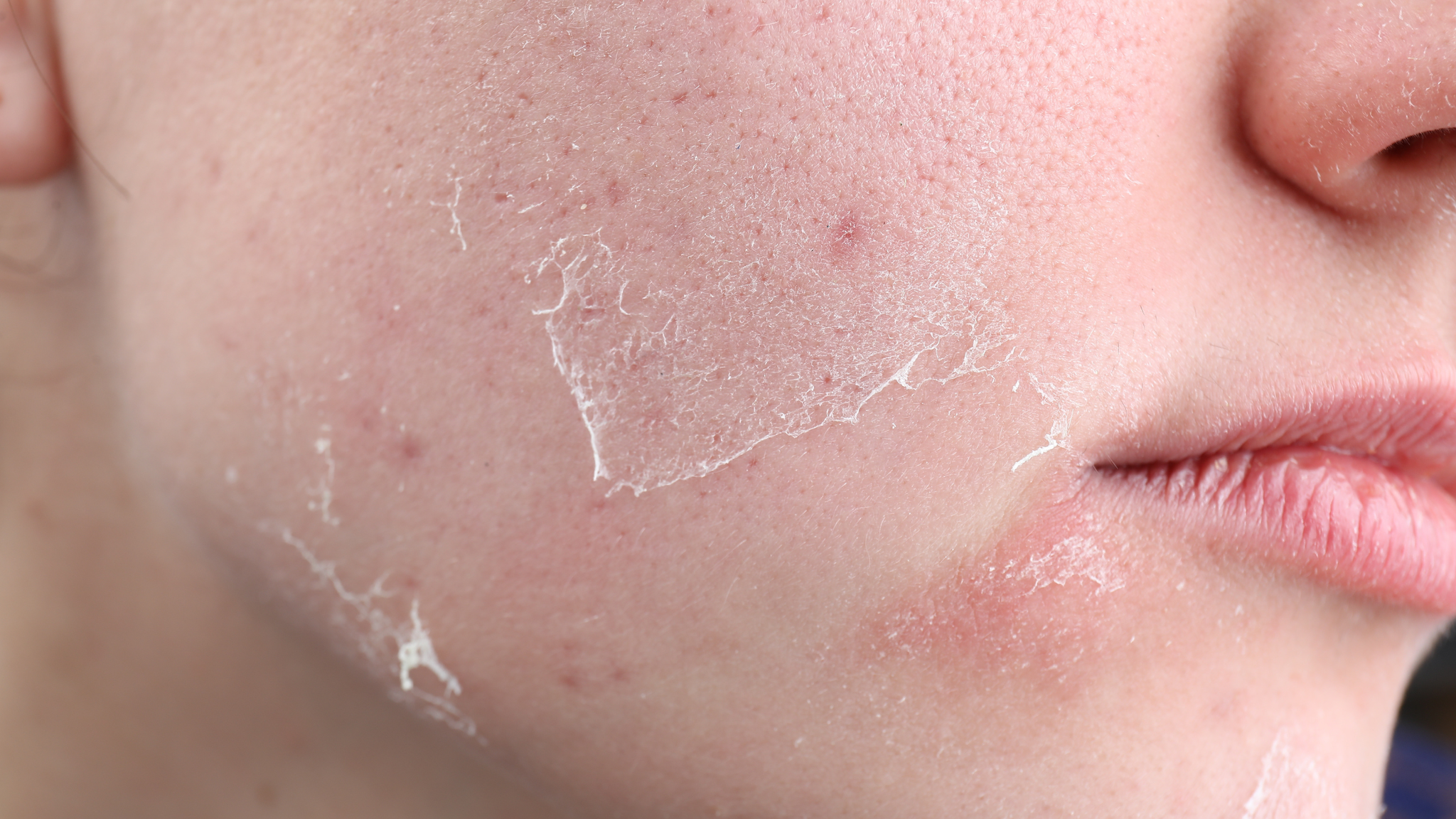 What to Use After Microneedling for Dryness and Peeling