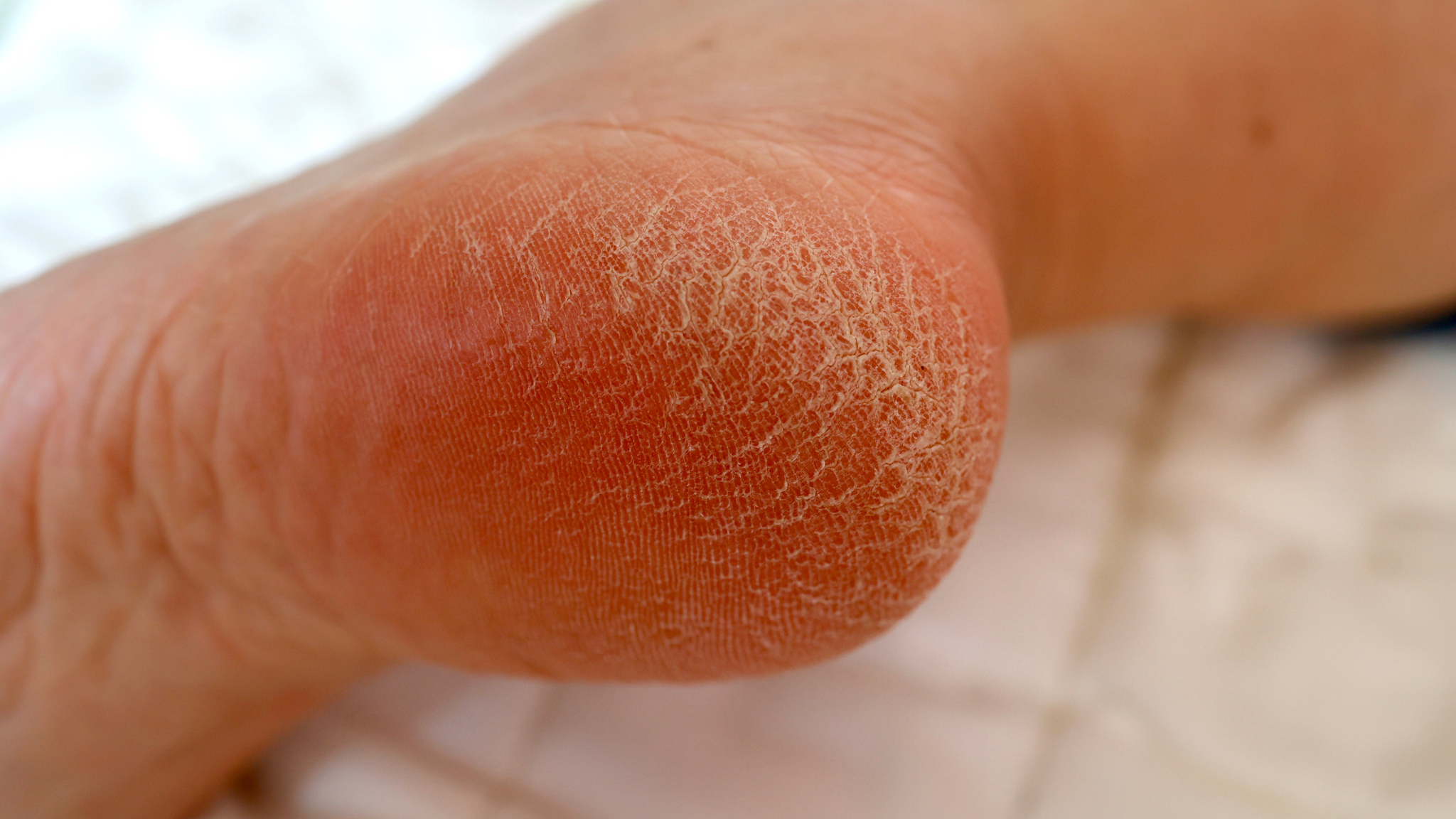 Close-up image of a heel with dry, rough, and cracked skin, showing visible flaking and thickened areas typical of calluses.