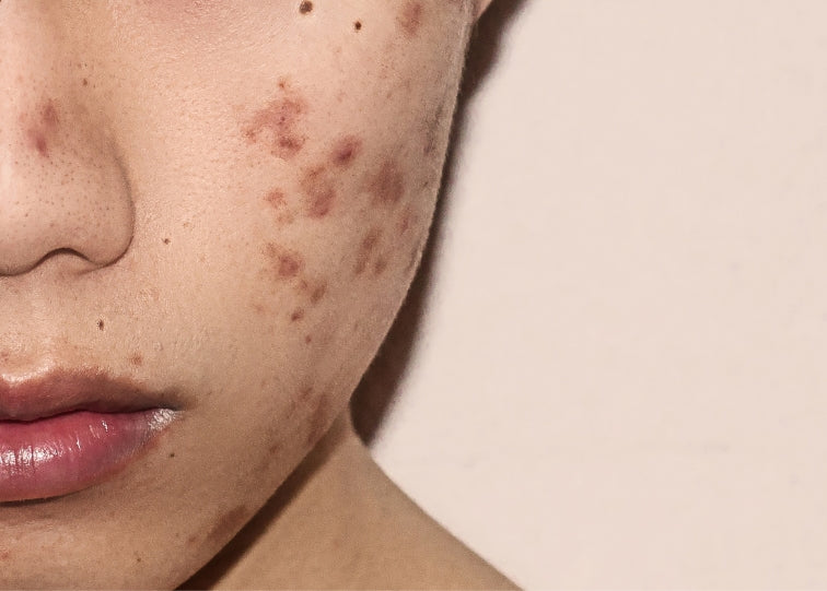Lady with acne scars