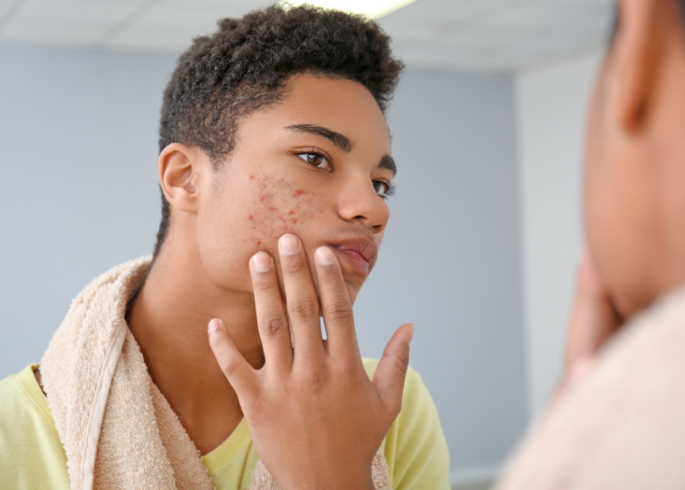 Ebanel Acne Bio Drying Lotion: A Comprehensive Guide