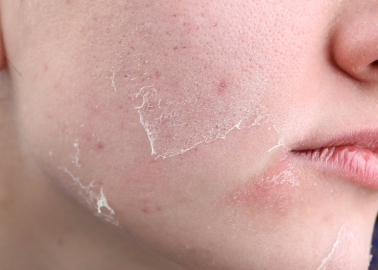 How to Combat Dry Skin During Winter