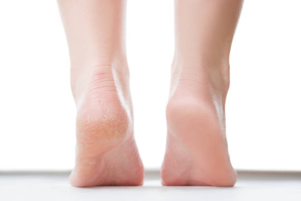 The Link Between Diabetes and Cracked Heels