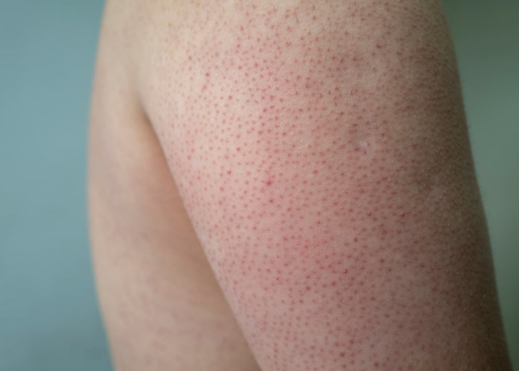 Keratosis Pilaris on arm