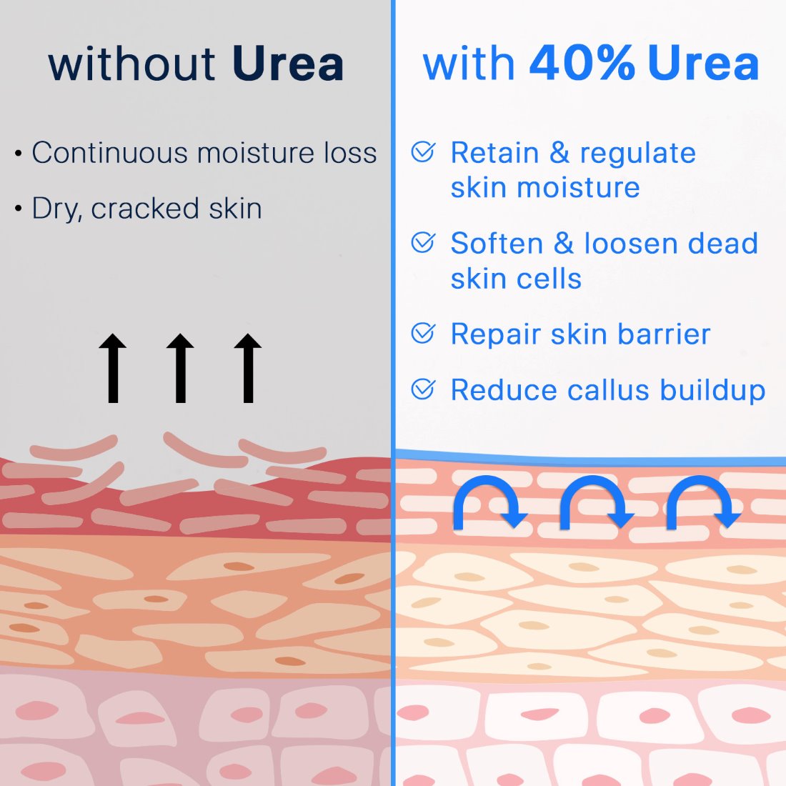 Comparison Photo of skin with and without Ebanel 40% Urea Cream
