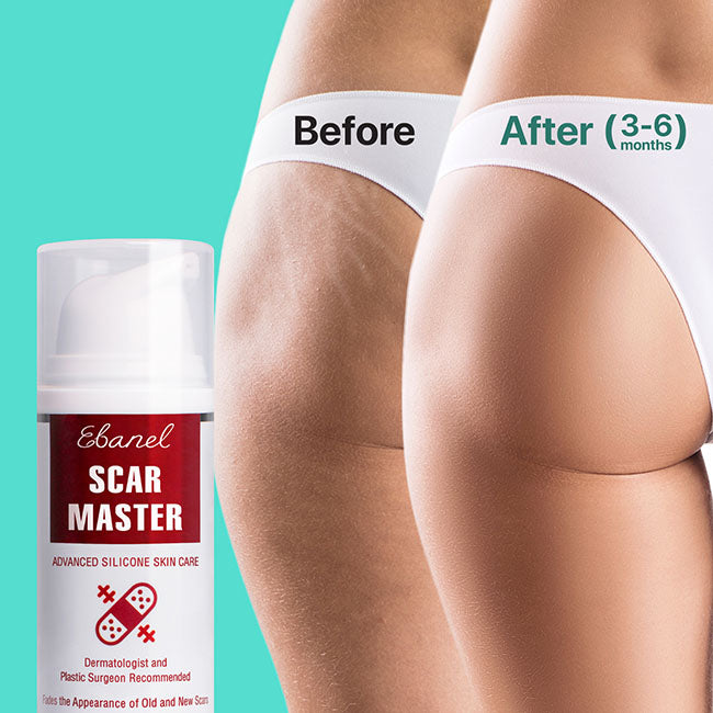 Before and After of Ebanel Scar Master on Stretch Marks